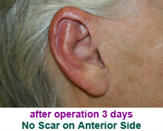 plastic-surgery-prominent-ear 